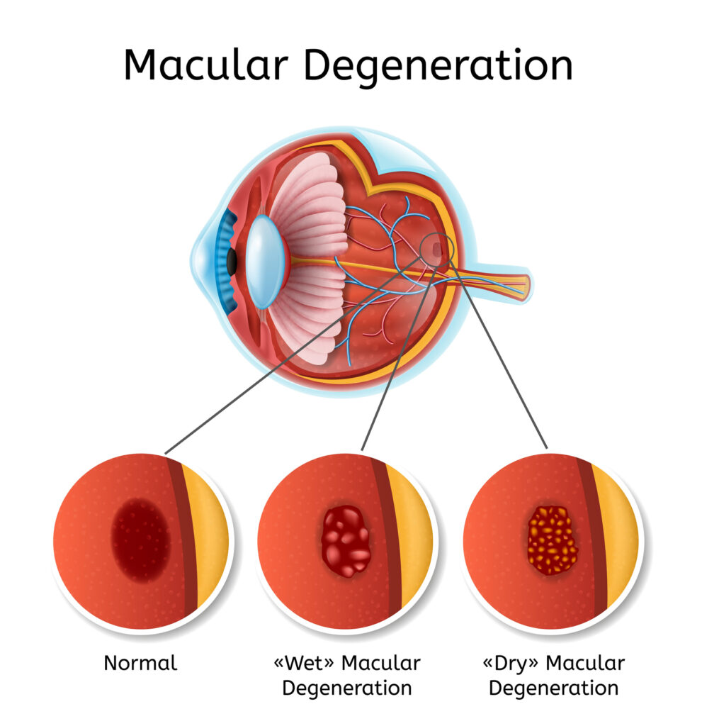Macular Degeneration Vector Medical Diagram with Eye Anatomy Internal Structure Illustration and Eyesight Disease Types Explanation. Age Related Eyesight Problem, Vision Loss Chart on White Background
